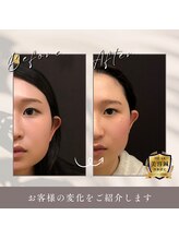 うぃず鍼灸整骨院/【立体造顔美容鍼・むくみ改善】