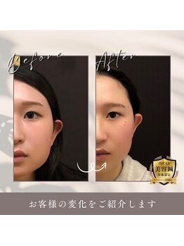 うぃず鍼灸整骨院/【立体造顔美容鍼・むくみ改善】