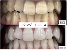 ホワイトニングショップ 明石大久保店/【BeforeAfter】