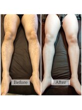 バナナ 福井店(Banana)/メンズ脚脱毛ビフォーアフター