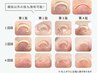 【フットネイル*巻き爪矯正】ジェルネイル*ペディバランス クリアジェル
