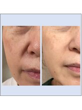 シュシュレ 博多(ShushuLe)/50代３ヵ月/ハリ・ツヤ