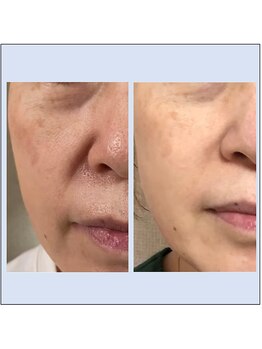 シュシュレ 博多(ShushuLe)/50代３ヵ月/ハリ・ツヤ