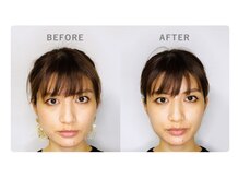西宮しおりビューティーサロン(西宮しおりbeauty salon)/美容鍼 before(左)→after(右)5