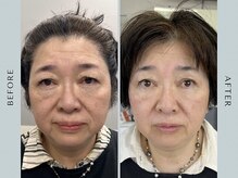 サロン ド エヌ(Salon de N)の雰囲気（エクソリフトで最新技術の肌改善が出来ます♪）