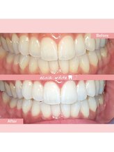 エクシアホワイトニング 札幌琴似店/ホワイトニングビフォーアフター