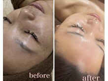 日焼けによるシミ、毛穴、しわ、乾燥肌を内側から整え艶玉肌へ