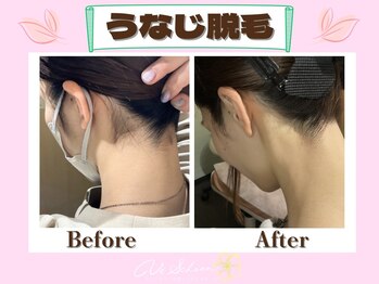 ヴィ シェーン(Vi Schoen)/うなじBefore/After 【W型】