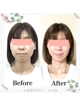 木の葉の写真/【実力派小顔専門店】「あれ？老けた？」疲れて見える顔、卒業しませんか？鏡を見るのが楽しみに♪