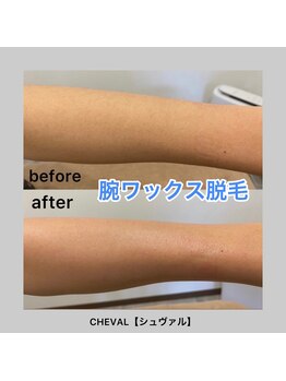 シュバル(CHEVAL)/腕ワックス脱毛