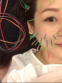 ジェイペック鍼灸整骨院/美容鍼40本スタンダード