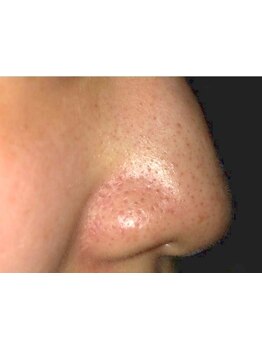 毛穴ケアをしたい