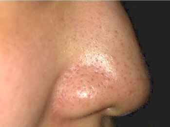 メナードフェイシャルサロン 丸の内ヒルズの写真/自宅ケアで落としきれない角栓・毛穴の黒ずみに◎お肌に負担をかけず優しく、徹底ケア♪毛穴の開きも解決!
