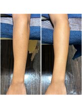 カナウ(KANAU)/腕もこんなに綺麗になります！