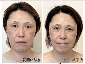 幸せ甦顔/のっぺり面長からふっくら卵型へ