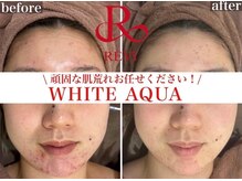 エステが初めての方もピーリング専門店にお任せください！