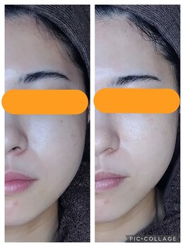 マックス(MAX)/むくみ解消/リフトアップ