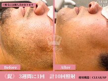 フェレザ 新潟(Felleza)/男性ビフォー＆アフター写真
