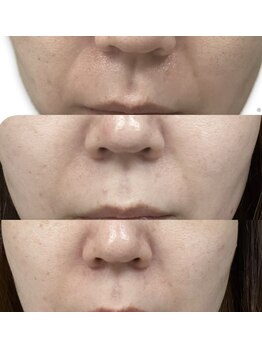 フェリス(feliz)/Before After[美肌フェイシャル]