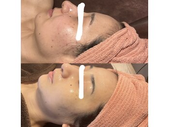 ヴィーナス(Venus)/白玉スキンフェイシャル