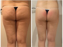 ピュウリリアーナ(Piu liliana)の雰囲気（40代のお客様☆デコボコセル脂肪改善!!）