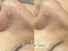 リテルナ(Re.terna)/■毛穴洗浄・毛穴ケアコース