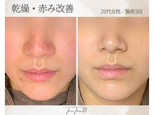 スリースリー 恵比寿(THREE THREE)/乾燥・赤みケア