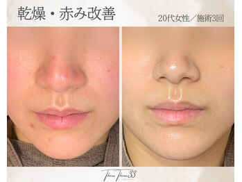 スリースリー 恵比寿(THREE THREE)/乾燥・赤みケア