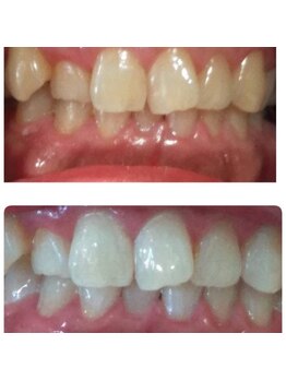 サロン シェリミー(Cheri mi)/セルフホワイトニング