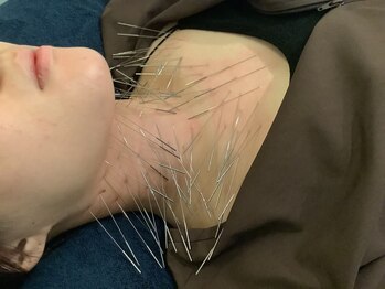 上野毛駅前整骨院 鍼灸院/喉の詰まりへの鍼