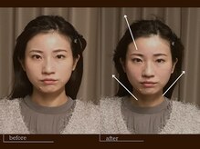 クレスト(CREST)/ビフォーアフター【小顔名古屋】