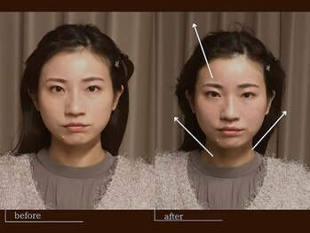 クレスト(CREST)/ビフォーアフター【小顔名古屋】