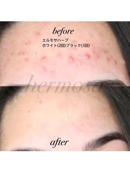リボーテ(Re-Beaute)/エルモサハーブフェイシャル