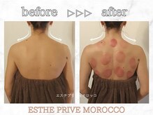 エステプリヴェモロッコ(ESTHE PRIVE MOROCCO)/人気No.1カッサカッピング