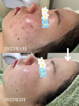 ルーチェ(LUCE)/本格ハーブピーリング