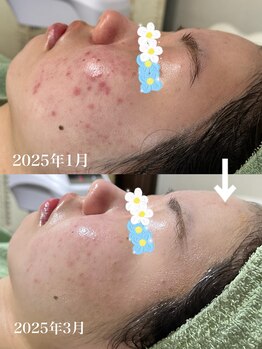 ルーチェ(LUCE)/本格ハーブピーリング