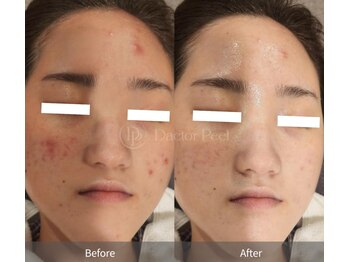 ビューティーザイオン(Beauty zion)/ニキビ肌改善