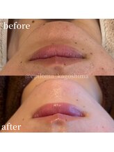 エピロマ(EPILOMA)/鹿児島市/宇宿/肌質改善