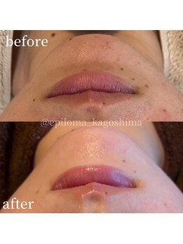 エピロマ(EPILOMA)/鹿児島市/宇宿/肌質改善
