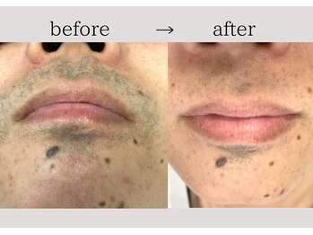 アネーロ(anhelo)/ヒゲの処理がめんどくさい方必見