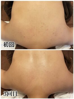 ピリナ 名古屋/【背中ハーブピーリング】症例