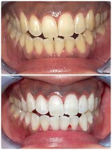 エクシア ホワイトニング 富山店/ビフォーアフター写真☆