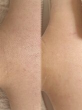 アトリーチェ ベレッツァ(ATTRICE Bellezza)/全身脱毛