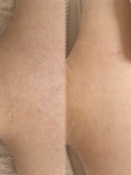 アトリーチェ ベレッツァ(ATTRICE Bellezza)/全身脱毛