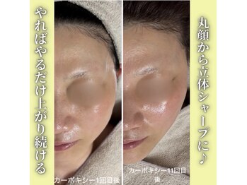 ハニエル(Haniel)/カーボキシー症例