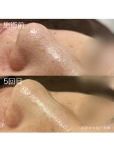 ルルラ リコ(lulula rico)/症例写真/毛穴洗浄