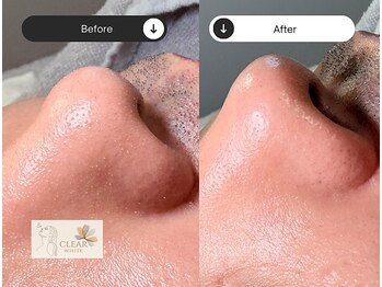 クリアホワイト(Clear White)/Before☆After