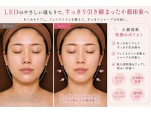 トータルヘルスビューティーカズ(TotalHealthBeauty KAZU)/【小顔矯正】光の森/光美容