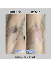 シュバル(CHEVAL)/脇ワックス脱毛