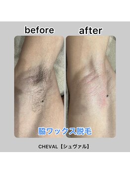 シュバル(CHEVAL)/脇ワックス脱毛